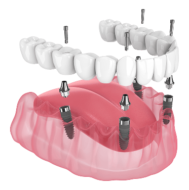Diagram of All on 4 procedure